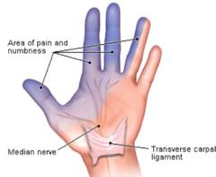 Carpal Tunnel Syndrom (CTS) and Chiropractic Treatment