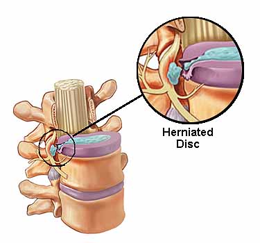 Herniated disc and chiropractic