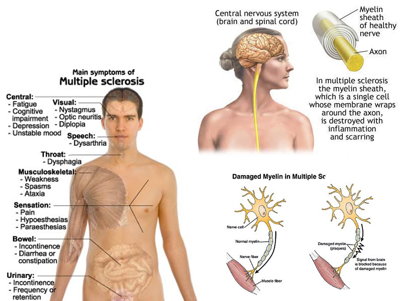 Multiple Sclerosis (MS) and Chiropractic